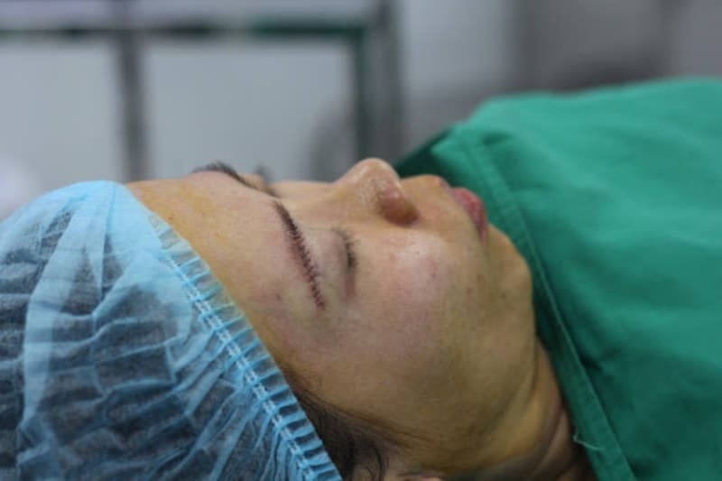 Nâng chân mày xóa sẹo trong bao lâu? 4 nguyên nhân để lại sẹo sau nâng chân mày