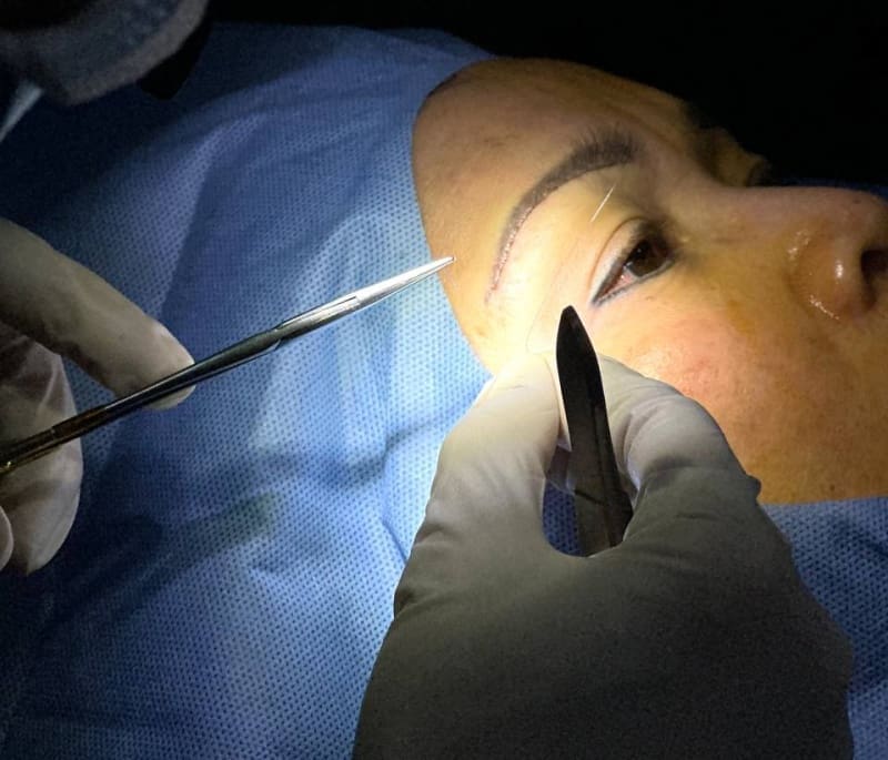 Nâng chân mày xóa sẹo trong bao lâu? 4 nguyên nhân để lại sẹo sau nâng chân mày